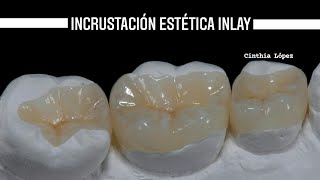 Incrustación Estetica [upl. by Hanid]