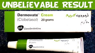 Dermovate Cream Review Benefits Uses Price Side Effects [upl. by Asilet]