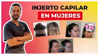 🙋‍‍ CASO REAL Injerto Capilar antes y después  3581 UFS  Resultados increíbles 👏‍‍ [upl. by Annol]