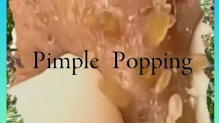 Pimple amp Blackheads Popping  38 [upl. by Curr207]