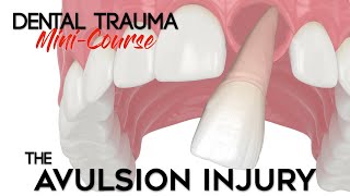 Dental Trauma MiniCourse  Part 12  Dental Trauma Guide  The Avulsion Dental Injury [upl. by Reyaht]