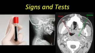 Retropharyngeal Abscess [upl. by Dearden]