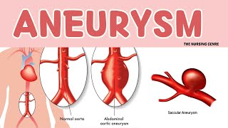 ANEURYSM  Blood vessel disorder brain cardio cardiovasculardisease heart cardiovascularsystem [upl. by Mont]