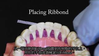 Ribbond Splint  Chinese [upl. by Ojybbob267]