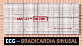 ECG  Eletrocardiograma com Bradicardia Sinusal [upl. by Toole275]