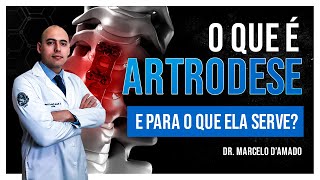 ARTRODESE  CIRURGIA QUE MELHORA A DOR PORÃ‰M PERDE O MOVIMENTO  SAIBA O QUE Ã‰ [upl. by Norreht]