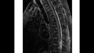 Leptomeningeal Disease LMD Symptoms [upl. by Gobert]