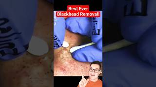 Perfect BLACKHEAD REMOVAL  Best Blackhead Extraction shorts [upl. by Kaycee109]