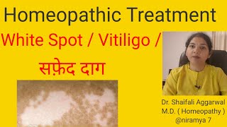 White spot Vitiligo सफ़ेद दाग Homeopathic Treatment for White spot  Vitiligo सफ़ेद दाग [upl. by Eserahs]