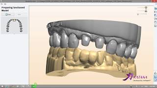 Digital Model Design 3Shape Impression Scan [upl. by Yadroc]