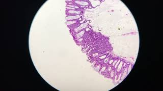 Sessile serrated lesion with serated dysplasia [upl. by Ierbua320]