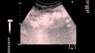 68M complained abdominal fullness and pain for 5 days [upl. by Gerrit964]