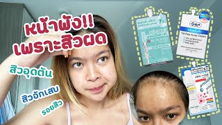 รีวิวยาแต้มสิวเซเว่น สามตัวสุดปัง Clear NoseYanhee Acne CreamRojukiss Acne Spotless Serum [upl. by Hyo]