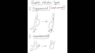 Gastric Volvulus gastrointestinal mbbs neetpg plab usmle fmge inicet [upl. by Low]