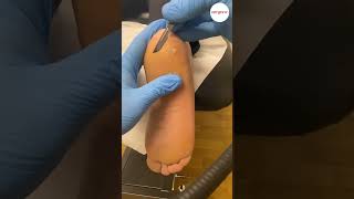 Thick Heel Skin Callus Removal With A Scalpel In Podiatry Clinic [upl. by Niarb99]