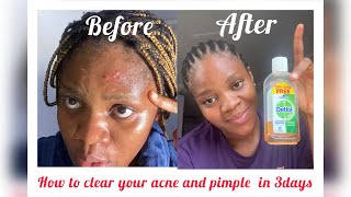 HOW TO USE DETTOL LIGUID ANTISEPTIC TO CLEAR ACNE AND PIMPLESget rid of pimples dettol clearskin [upl. by Canter]