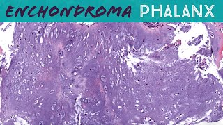 Enchondroma special rules for cartilage tumors in phalanx fingers toes hands feet bone pathology [upl. by Gerry]