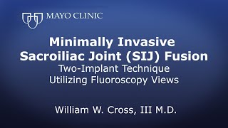 Minimally Invasive Sacroiliac Joint SIJ Fusion Twoimplant technique utilizing Fluoroscopy views [upl. by Alvar838]