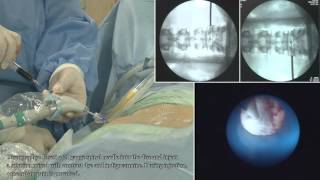 II TELA  Transforaminal Epiduroscopic Laser Annuloplasty   full procedure [upl. by Dhiren]