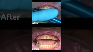 Full Mouth Restoration  Teeth Attrition Treatment shorts dentist [upl. by Uzial]