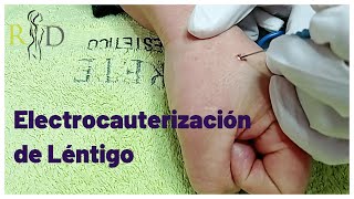 Electrocauterización de Léntigo Lunares Verrugas [upl. by Ettenay]