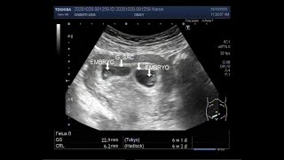 Ultrasound Video showing Early first trimester  6 weeks 01 day  twin Pregnancy [upl. by Daphie]