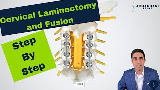 Posterior Cervical Laminectomy and Fusion  Procedure details recovery and expectations [upl. by Eeldivad]