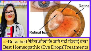 रेटिनल डिटैच्मेंट Retinal Detachment Homeopathic Medicine Retinopathy Homeopathic Treatment [upl. by Turnbull]