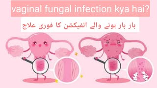 Aurton me Fungus ka infection candidiasis white discharge ka ilaj UrduHindi [upl. by Yelroc]