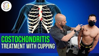 Costochondritis Treatment with Cupping [upl. by Weight827]