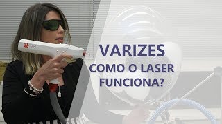 Tratamento de Varizes  Como Funciona o Laser  Dra Livia Lyra  Angiologista Belo Horizonte [upl. by Kieger]