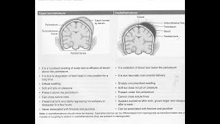 Cephalohematoma and Caput succedaneum  Short lacture [upl. by Noived]