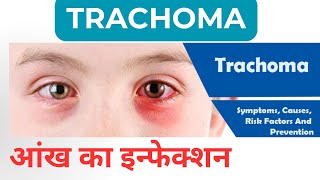 Trachoma रोहे आंख का इन्फेक्शन । कैसे फैलता है और क्यों [upl. by Shimberg]