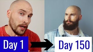 5 MONTH MINOXIDIL BEARD TRANSFORMATION [upl. by Hawkie]