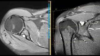 Shoulder pain from labral tear with paralabral cyst [upl. by Oyr]