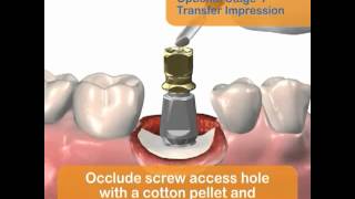 Implantes dentales secuencia completa [upl. by Vladimar57]