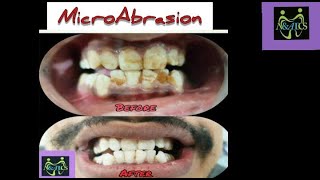 Microabrasion  Unsung heroic Dental Treatment [upl. by Aidnis]