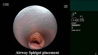 Hemoptysis Bronchoscopic endobronchial sphigot  Watanabe  placement with Glue instillation [upl. by Enirbas]