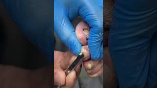 Ingrown toenail removal [upl. by Zoara]