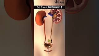 DJ Stent Removal  Retrograde Intrarenal Surgery  kidney stone treatment shorts [upl. by Elicia]