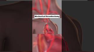 Mechanical Thrombectomy￼ [upl. by Torrie]