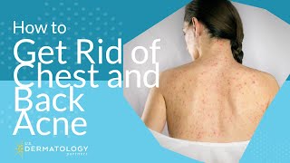 How to Get Rid of Chest and Back Acne [upl. by Lehacim]