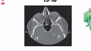 Ethmoid sinuses [upl. by Lotsirb]