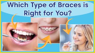 Types Of Orthodontic Treatment  Which Braces Are Right For You [upl. by Lewan900]