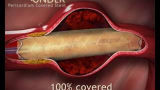 ITGI Medical Pericardium Covered Stent video produced by Virtual Point [upl. by Anneyehc]