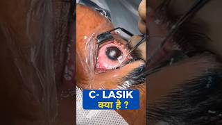 What Is C Lasik [upl. by Chiarra]