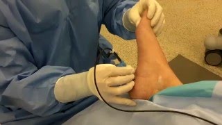 Radiofrequency Nerve Ablation for Heel Pain [upl. by Jacklin]