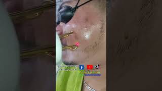 Acne scar CO2 laser treatment acnetreatment co2laser laser laserskincare bangladesh [upl. by Einwahs]