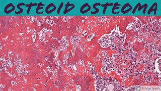 Osteoid Osteoma Bone Pathology Basics [upl. by Jasmin814]