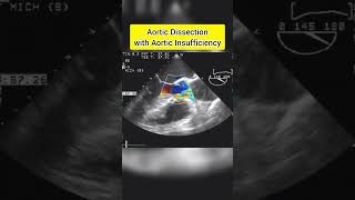 Aortic Dissection with Aortic Insufficiency echocardiography [upl. by Rebhun]